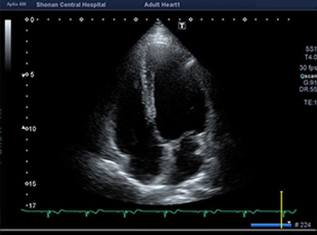 心臓超音波検査2