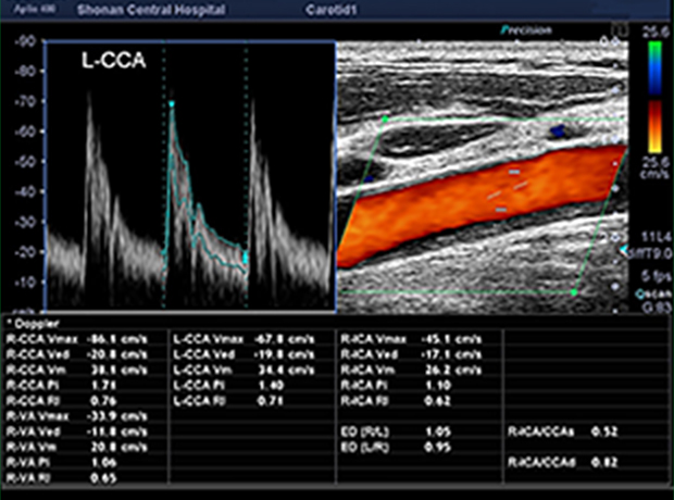 頸動脈超音波検査1